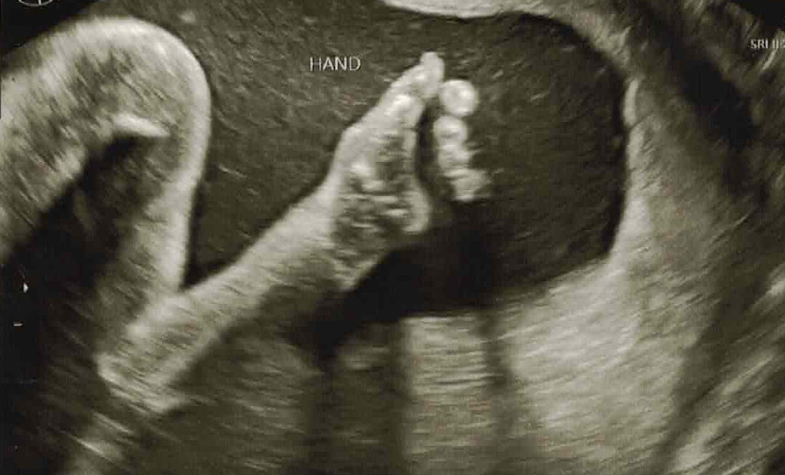 Sonogram of baby with thumbsup